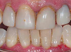 Before Treatment
